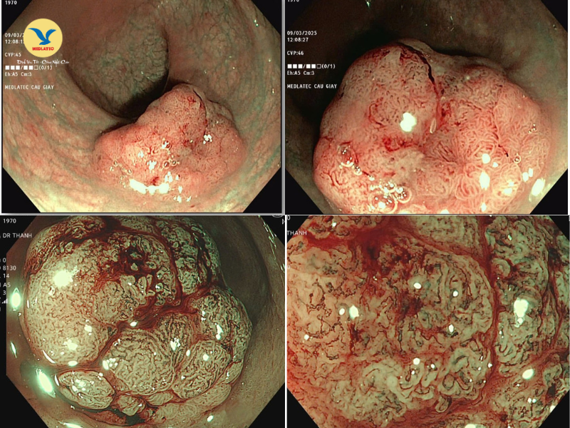 Hình ảnh polyp trực tràng phóng đại 