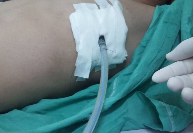 Dẫn lưu màng phổi là được thực hiện nhằm đưa chất lỏng (dịch) hoặc khí tích tụ ra khỏi khoang màng phổi