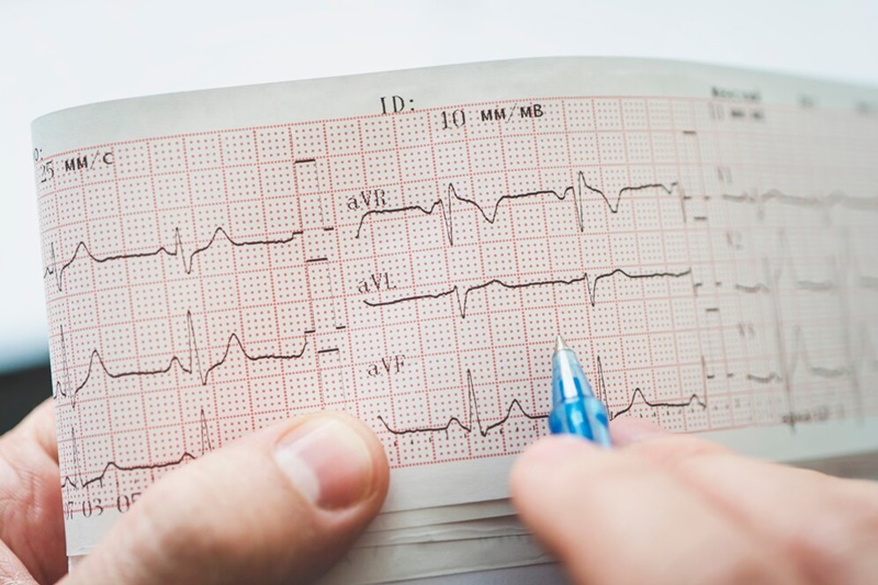 Nhiều trường hợp được chẩn đoán nhồi máu cơ tim bằng điện tâm đồ 