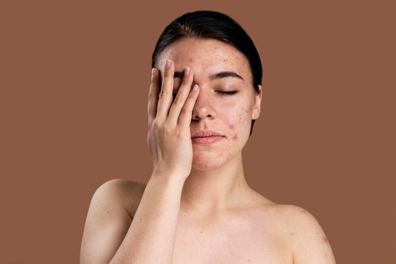 Da dầu mụn cũng cần được cấp ẩm