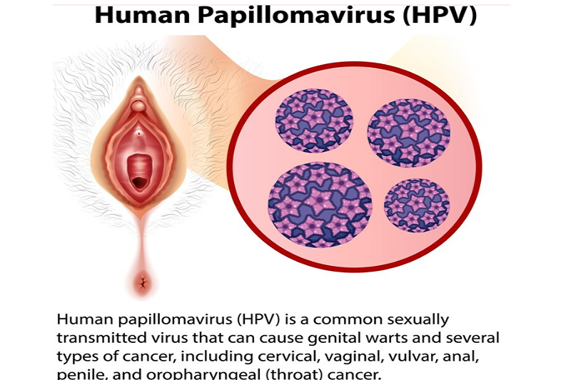 HPV có những chủng virus dễ tiến triển và gây nên bệnh ung thư ở cơ quan sinh dục