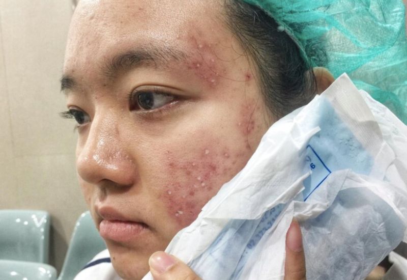 Phát ban mụn trứng cá có thể bị nhầm lẫn với nhiều bệnh lý da khác