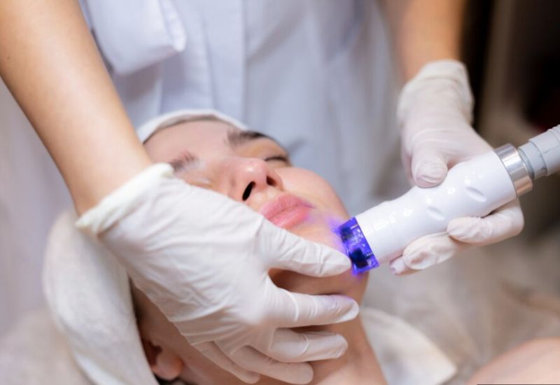 Liệu pháp ánh sáng xanh giúp tiêu diệt vi khuẩn C. acnes dưới da.