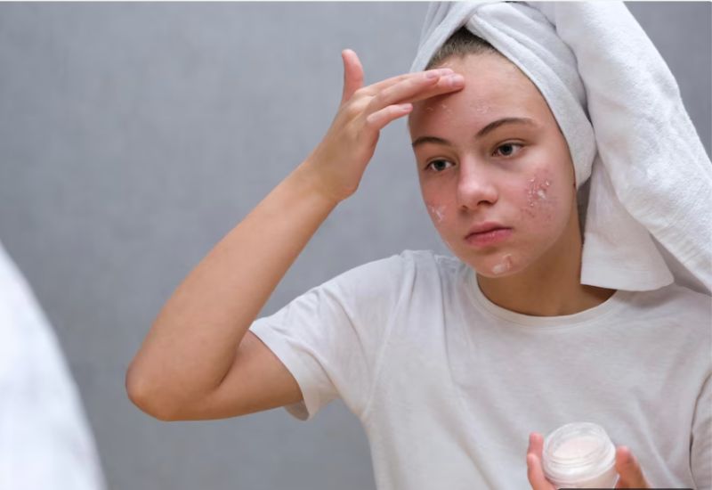 Chăm sóc da là phần không thể thiếu trong điều trị phát ban mụn trứng cá, ngăn ngừa tái phát