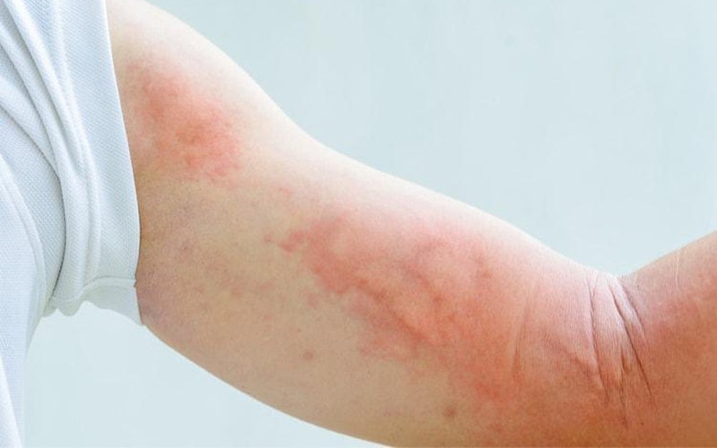 Ngứa, mẩn đỏ là một trong những dấu hiệu nhiễm ký sinh trùng 