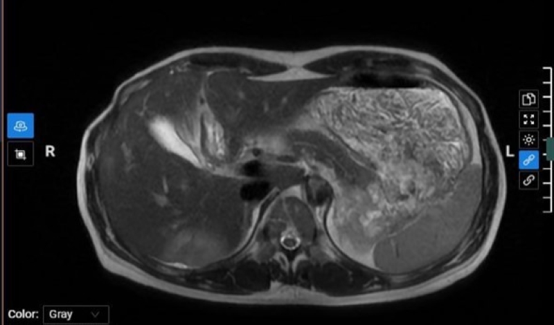 02 tổn thương trên gan phải được trên hình ảnh chụp MRI ổ bụng 