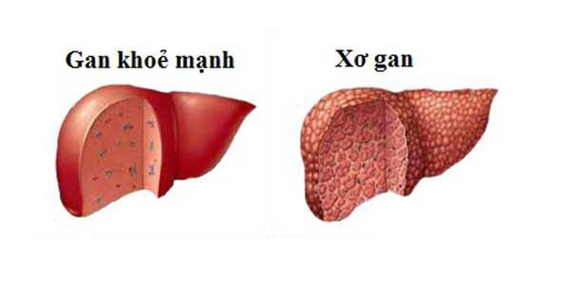Xơ gan là nguyên nhân hàng đầu dẫn đến bệnh não gan