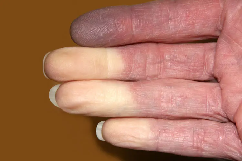 Hội chứng Raynaud là dấu hiệu khởi phát sớm và phổ biến nhất ở hơn 95% bệnh nhân.