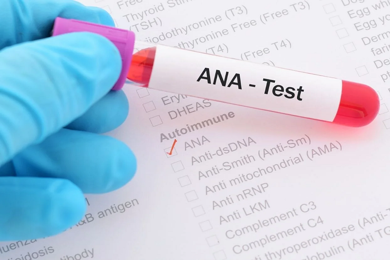 Xét nghiệm ANA dương tính > 90% bệnh nhân xơ cứng bì toàn thể.