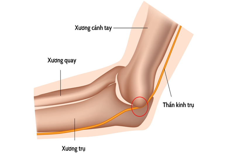 Hội chứng đường hầm xương trụ là do chèn ép hoặc kích thích lên dây thần kinh trụ