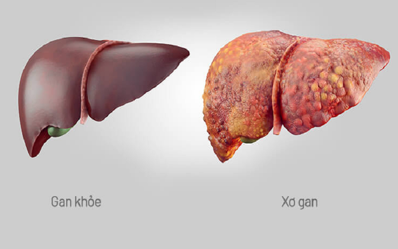 Xơ gan là nguyên nhân chính gây cổ trướng