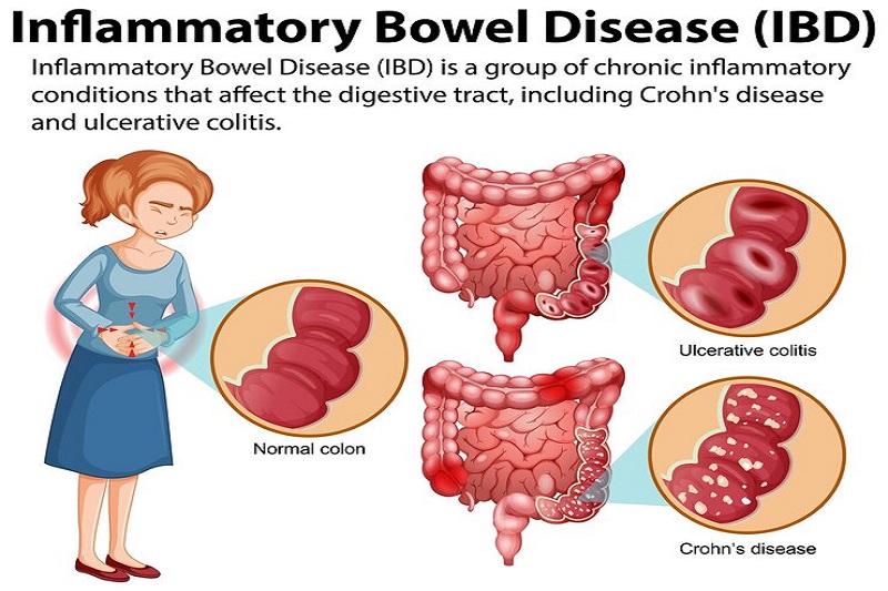 Mắc bệnh Crohn mạn tính làm tăng nguy cơ xuất hiện khối u ác tính đại tràng