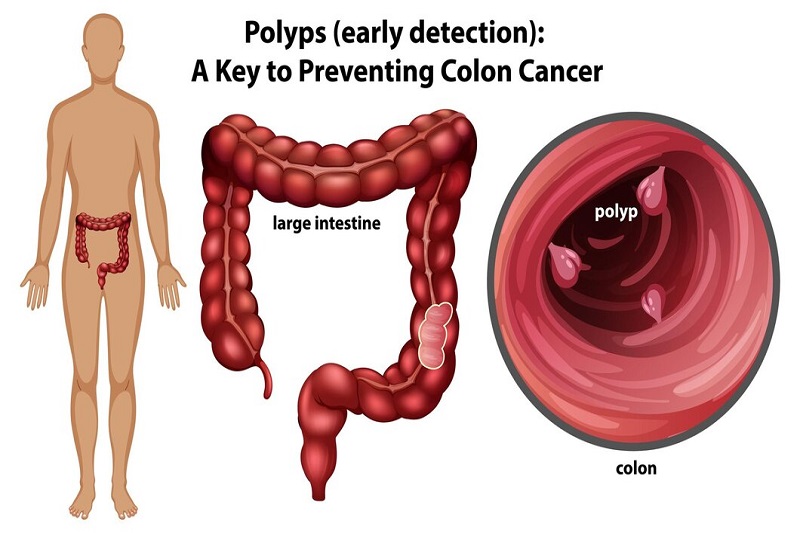 Tầm soát ung thư đại tràng phát hiện polyp để loại bỏ, ngăn chặn nguy cơ tiến triển khối u ác tính