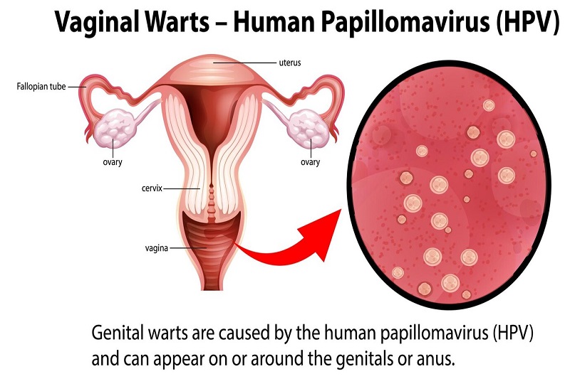 Virus HPV có thể là nguyên nhân gây ra nhiều loại ung thư nguy hiểm 