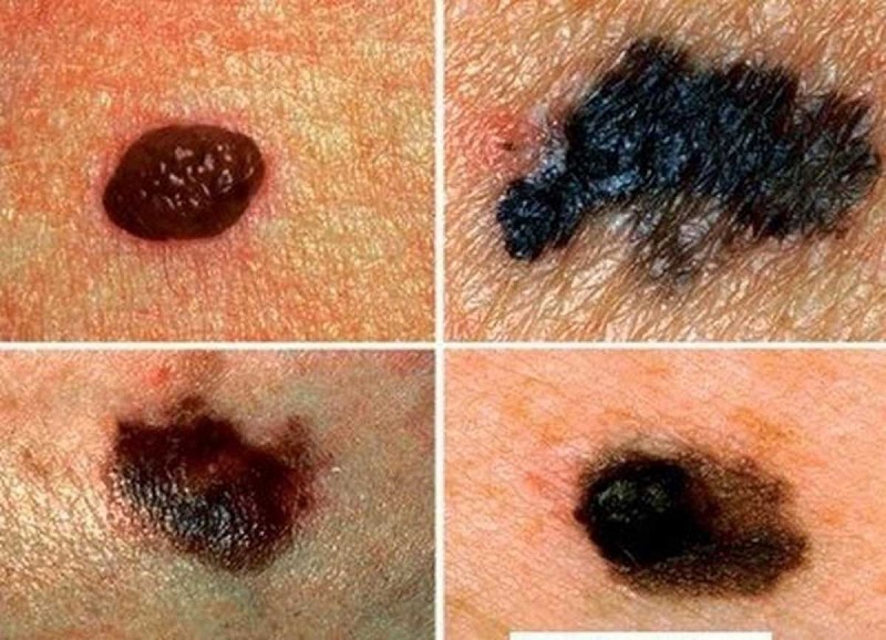 Nốt ruồi phát triển bất thường là dấu hiệu điển hình của bệnh