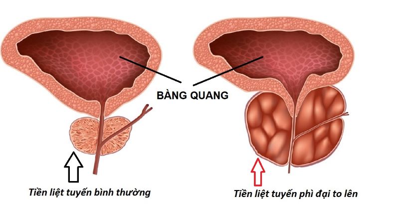 Hình ảnh minh họa tuyến tiền liệt bình thường (trái) và tuyến tiền liệt phì đại (phải) 