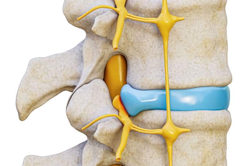 Chèn ép dây thần kinh dẫn đến dị cảm