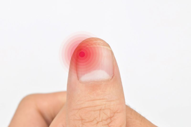 Viêm quanh móng thường do vi khuẩn gây ra