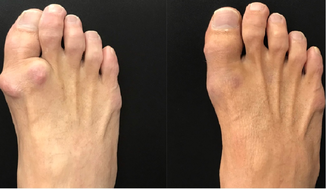  Biến dạng ngón cái (vẹo vào trong) do hạt Tophi ở người bệnh, viêm khớp bàn ngón do Gout