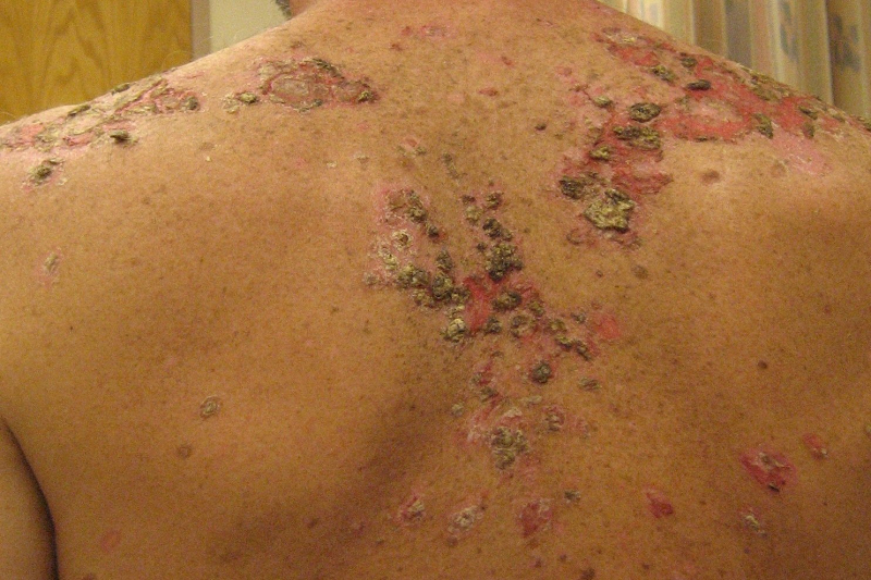 Pemphigus là nhóm bệnh tự miễn hiếm gặp, nếu không điều trị kịp thời dễ xảy ra các biến chứng nguy hiểm