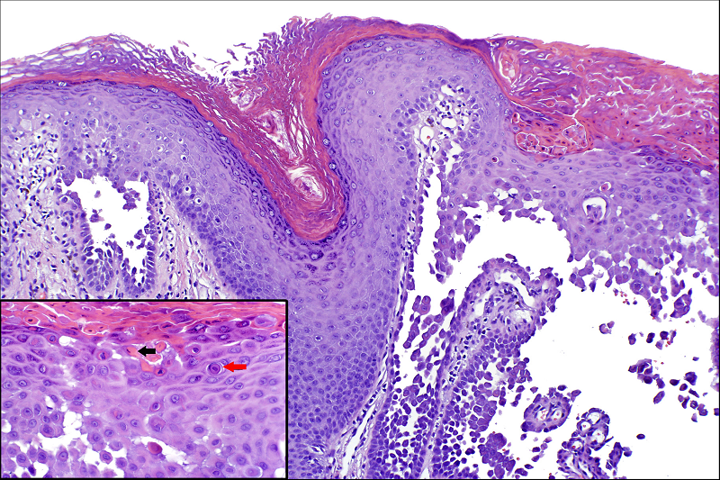 Hiện tượng ly gai (acantholysis) trên sinh thiết mô bệnh học.