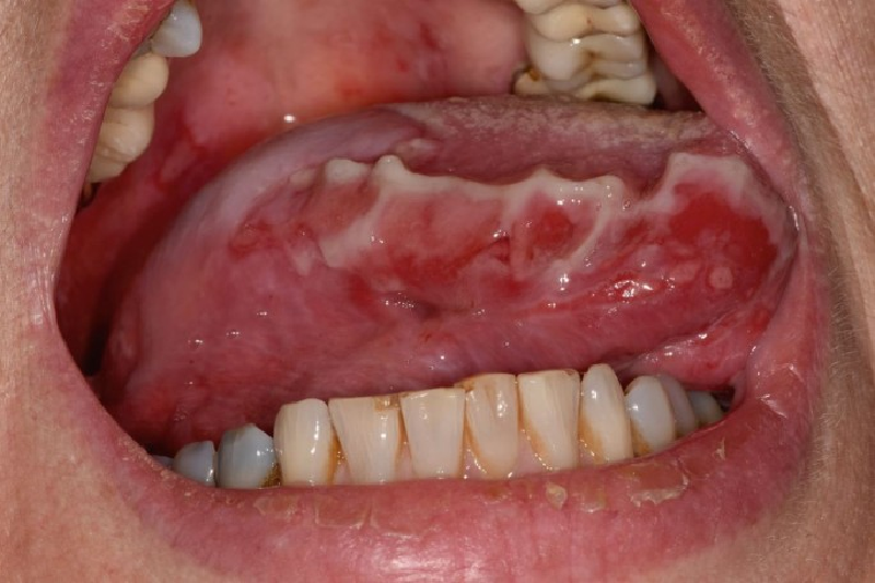 Bệnh pemphigus vulgaris đặc trưng bởi bóng nước, vết loét trợt ở niêm mạc miệng.