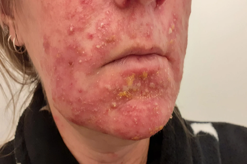 Hình ảnh cornflakes trong bệnh pemphigus foliaceus.