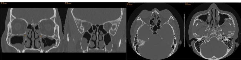 Hình ảnh CT mũi xoang cho thấy các bất thường liên quan đến viêm xoang