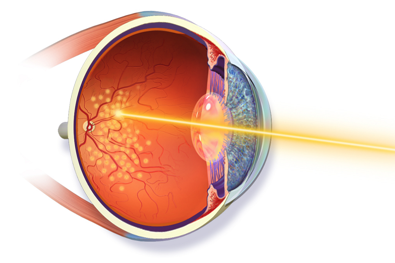 Laser quang đông võng mạc giúp làm tắc các tân mạch dễ vỡ, hạn chế nguy cơ xuất huyết.