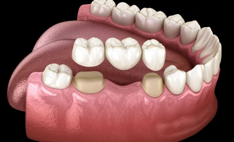 Cầu răng sứ giúp cải thiện chức năng ăn nhai hiệu quả