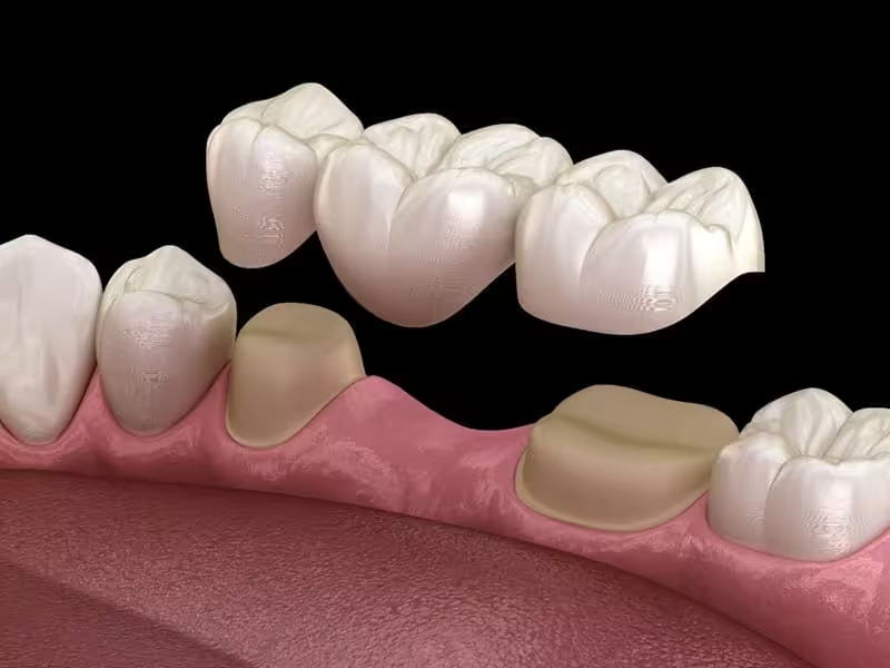 Cầu răng sứ được sử dụng với chức năng thay thế răng đã mất 