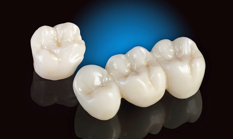 Răng sứ Titan Vita (Đức) là một trong những dòng sản phẩm chất lượng cao 
