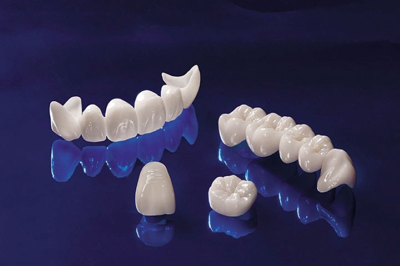 Răng sứ titan sở hữu nhiều ưu điểm nổi bật 
