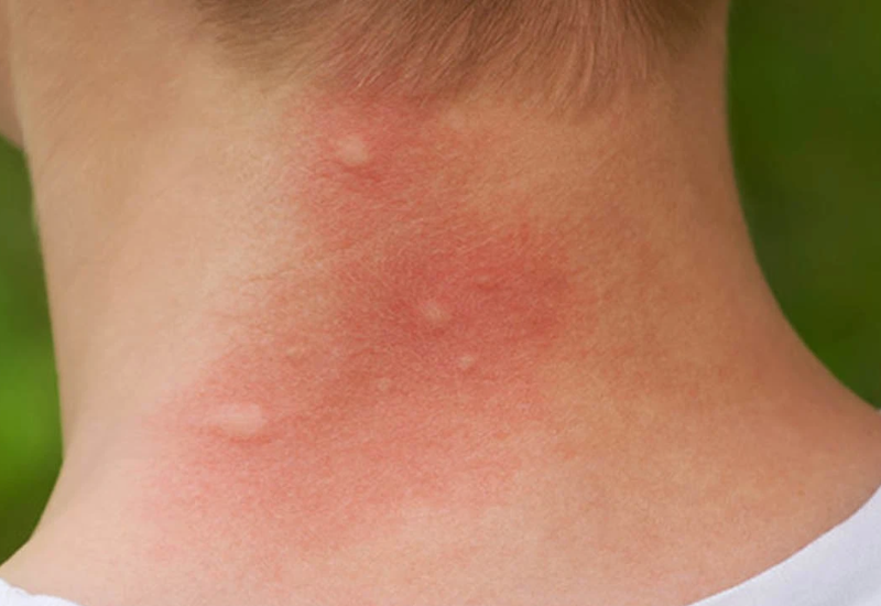 Phản ứng miễn dịch với nước bọt của muỗi khi bị muỗi đốt khiến da trẻ bị bị sưng cứng