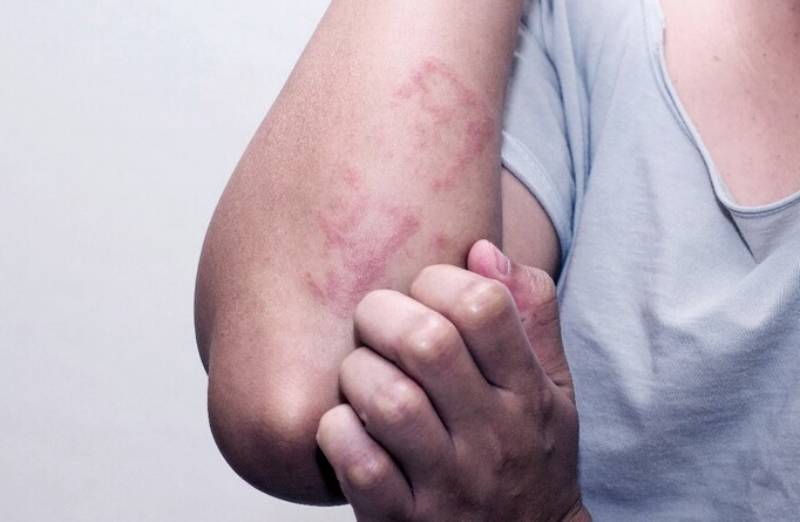 Nhiễm trùng da do vi sinh vật tấn công