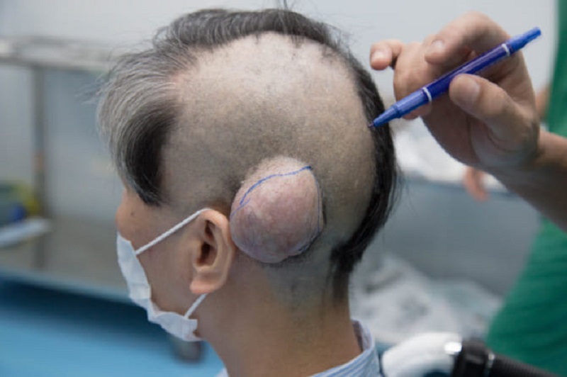 Người bệnh có u quái Teratoma ở vùng đầu