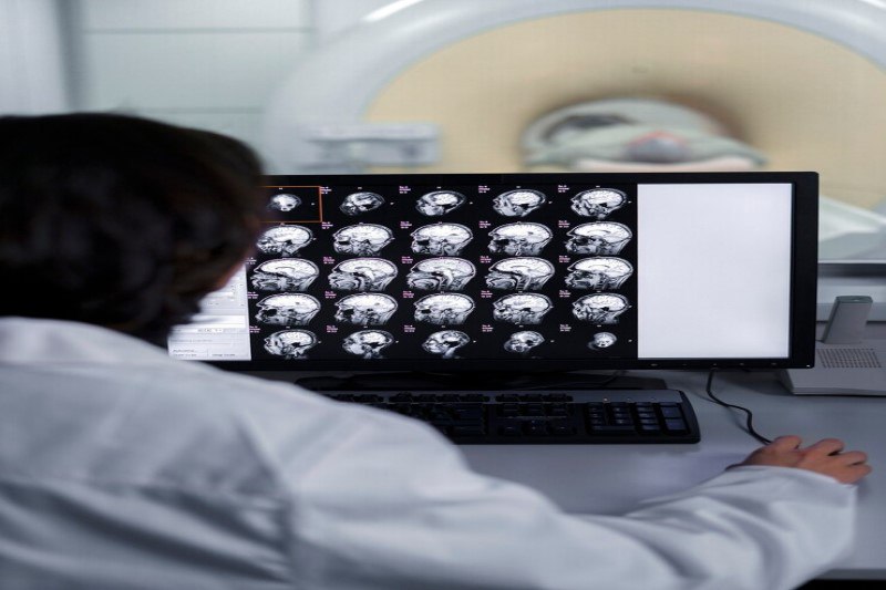 CT scan là cận lâm sàng chính trong chẩn đoán tiêu xương sọ