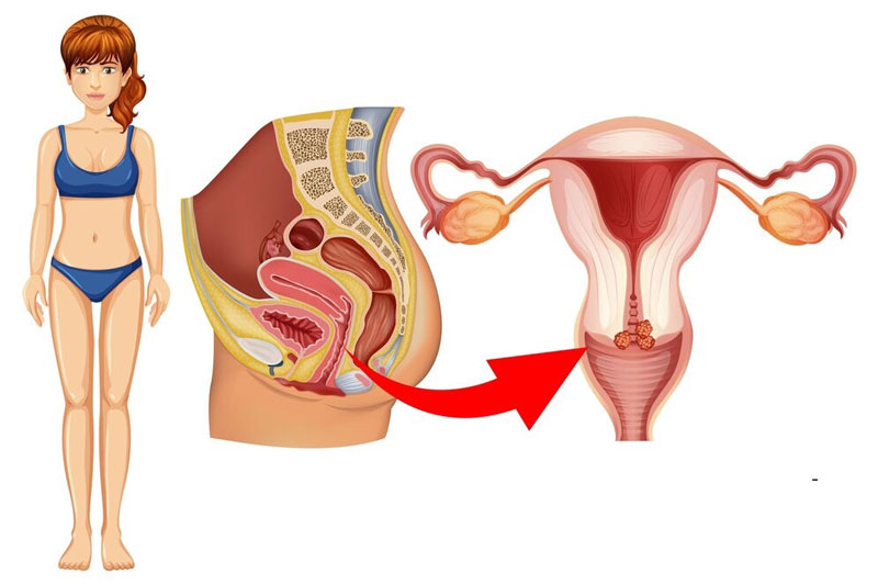 Tỷ lệ nữ giới mắc ung thư cổ tử cung bị nhiễm HPV 18 tương đối cao