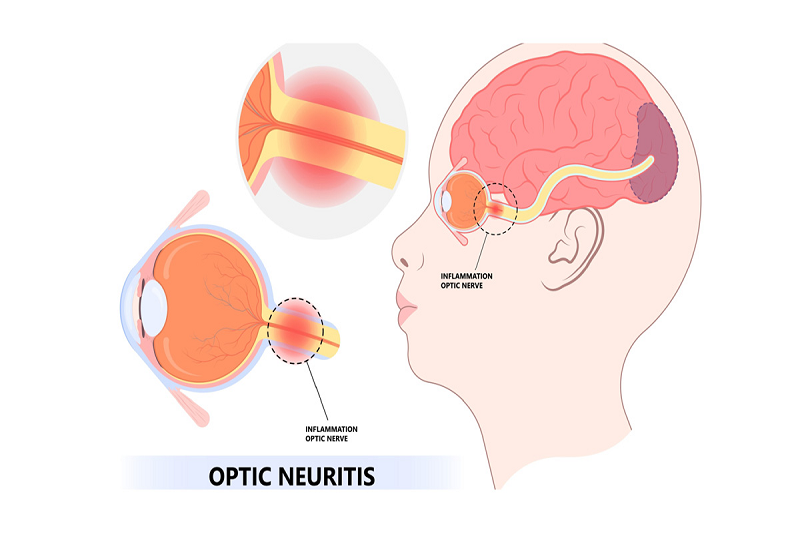 Viêm thần kinh thị giác là một nguyên nhân gây rối loạn thị giác phổ biến, thường gặp ở người mắc bệnh đa xơ cứng.