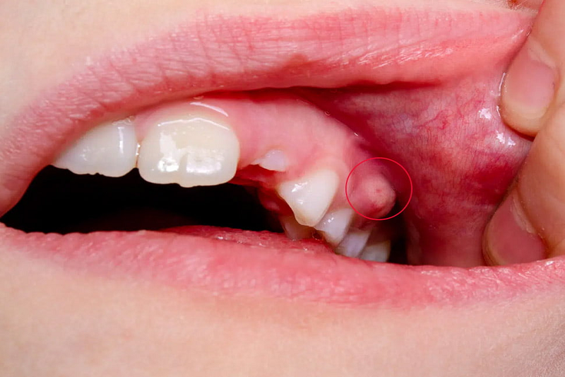 Dấu hiệu tụ mủ quanh chân răng có thể do tình trạng áp xe quanh chóp.