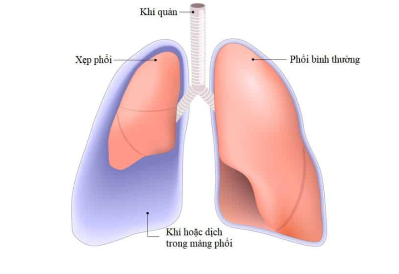 Có những yếu tố nào tăng nguy cơ phẫu thuật phổi trở nên nguy hiểm hơn?
