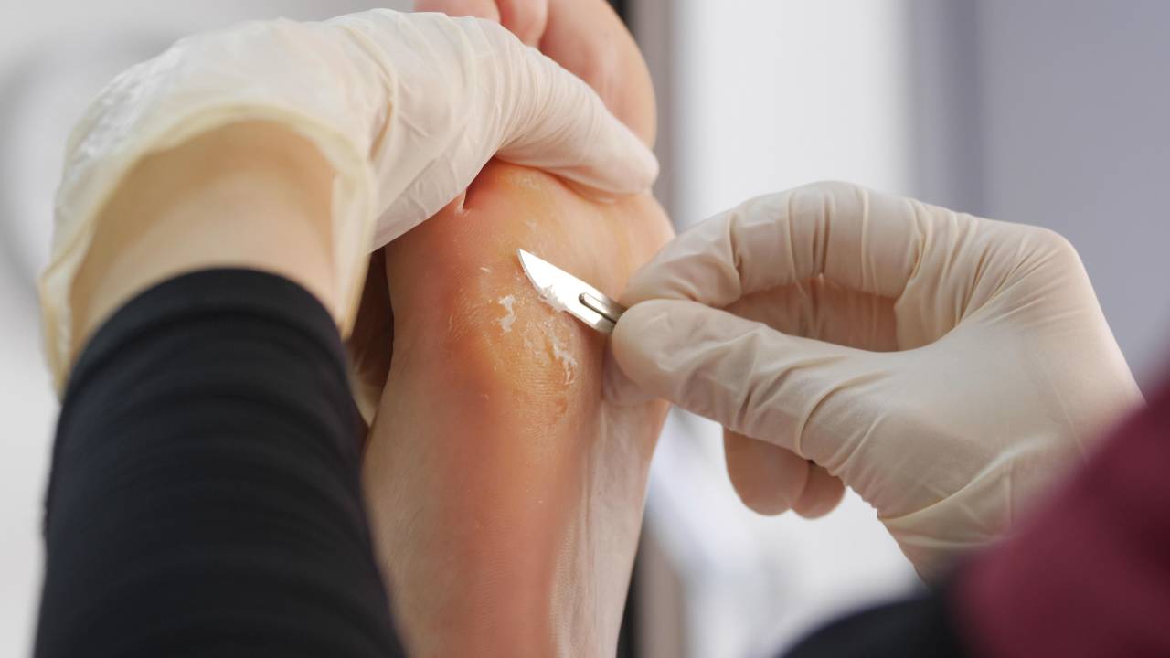 Gọt cắt lớp sừng hoặc lõi tổn thương có thể được chỉ định để điều trị mắt cá và chai chân