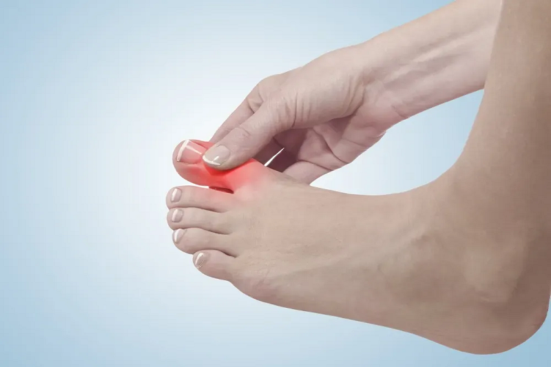 Viêm khớp ngón chân cái là nguyên nhân thường gặp gây đau bàn chân ở người trưởng thành.