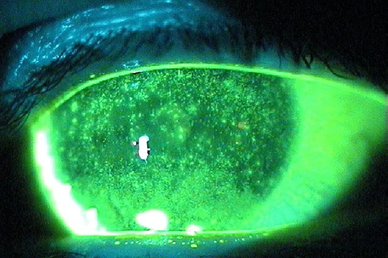Nhuộm fluorescein là phương pháp đơn giản và hiệu quả nhất để phát hiện viêm giác mạc chấm nông.