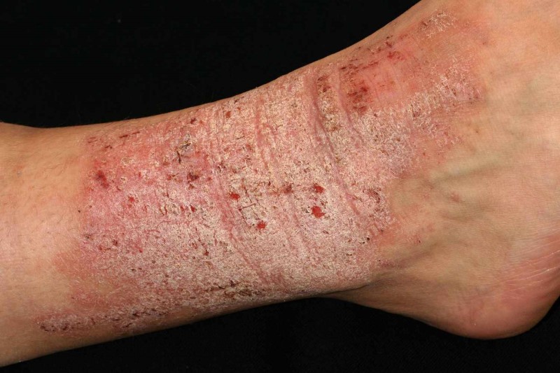 Lichen đơn dạng mãn tính thường xuất hiện sau bệnh lý nền da liễu