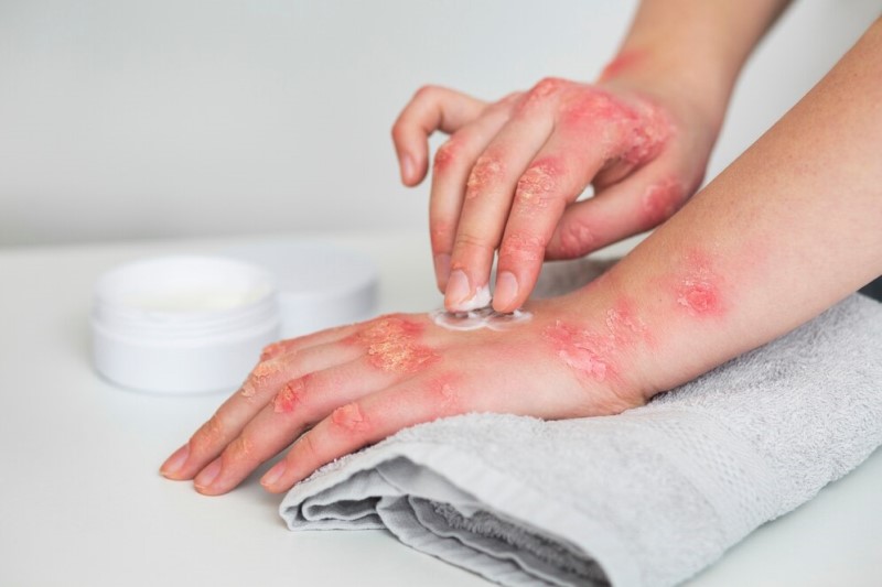 Gãi là yếu tố chính trong cơ chế bệnh sinh của lichen đơn dạng mạn tính