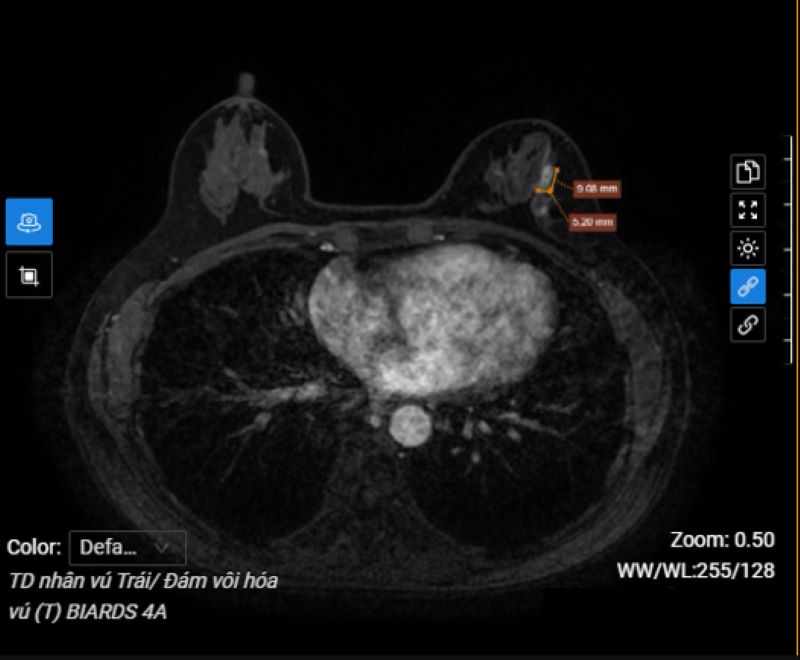 Hình ảnh MRI vú trái bệnh phân phát hiện đám vôi hóa phân loại BIRADS 4A 