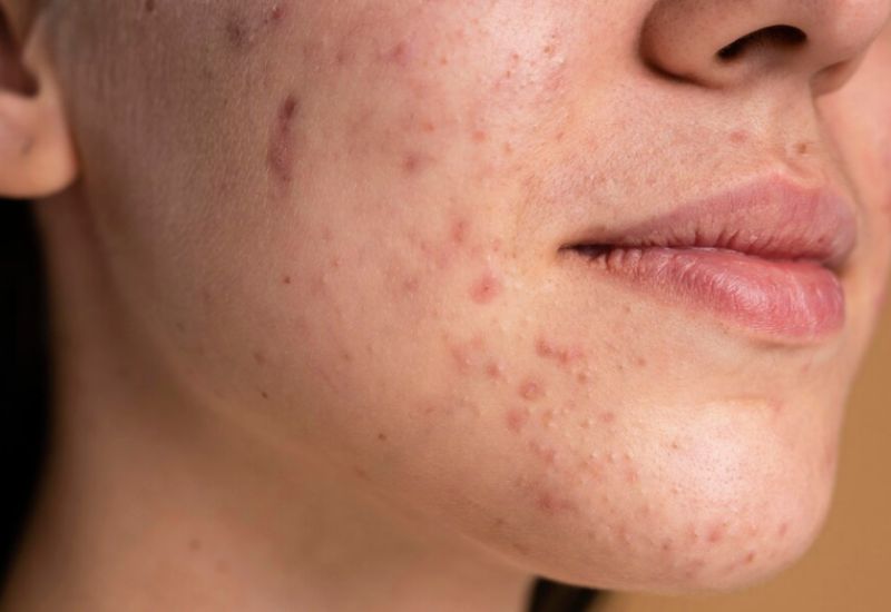 Người có làn da mụn cần chú ý nhiều hơn trong việc lựa chọn serum dưỡng da
