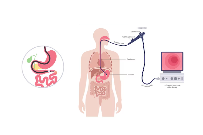 Hình ảnh mô phỏng nội soi mật tụy ngược dòng chẩn đoán bệnh sán lá gan