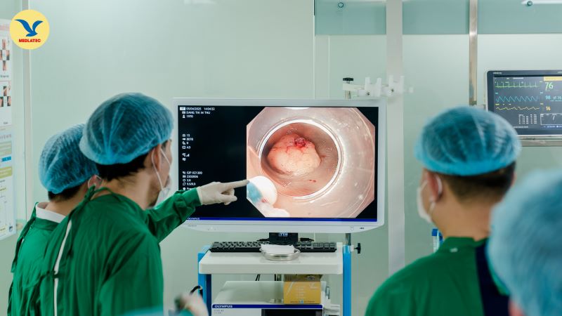 ESD - bước tiến vượt bậc trong điều trị ung thư đại tràng giai đoạn sớm